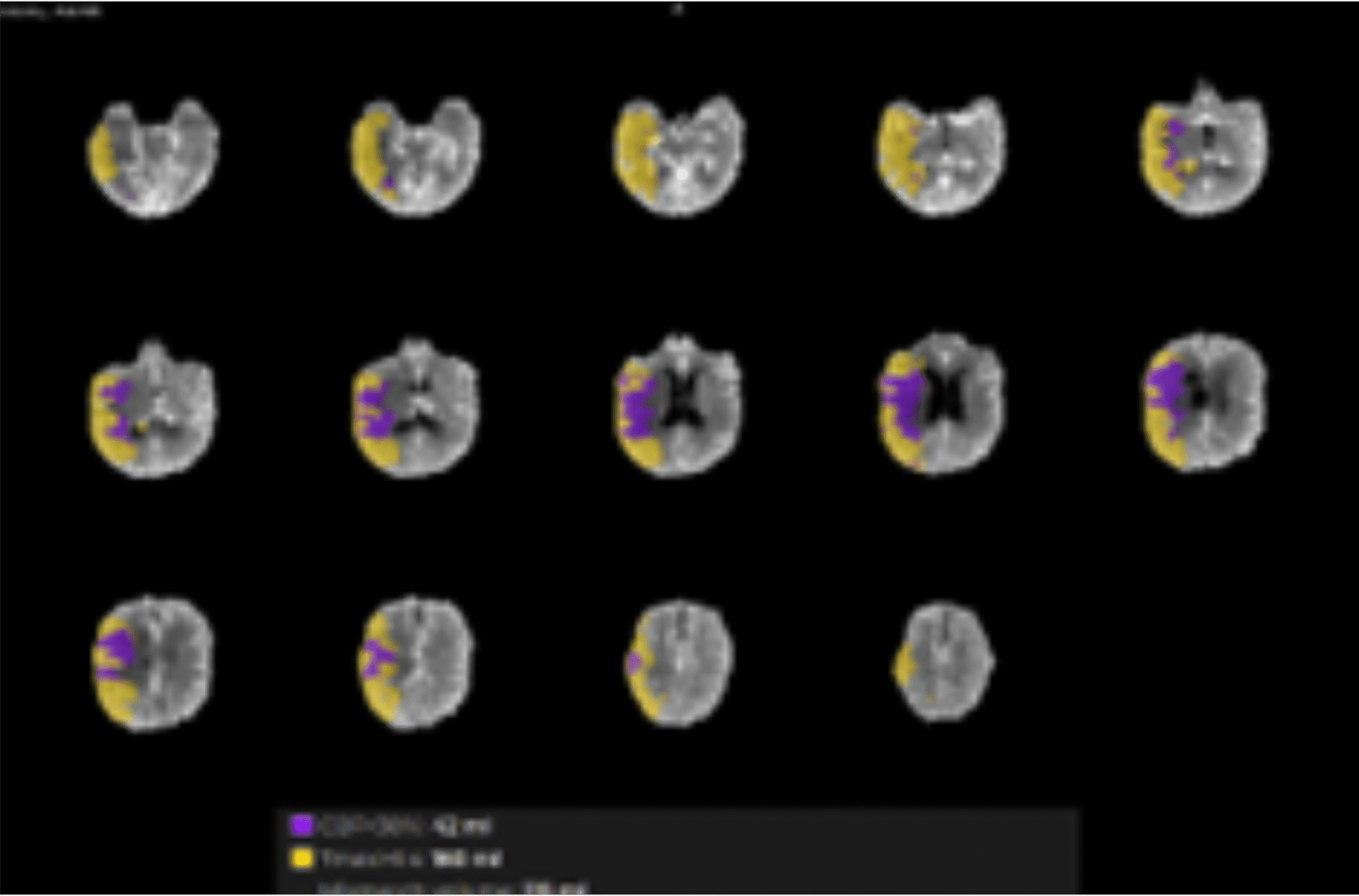 Webinar: Characterization of Cerebral Microvascular Architecture ...